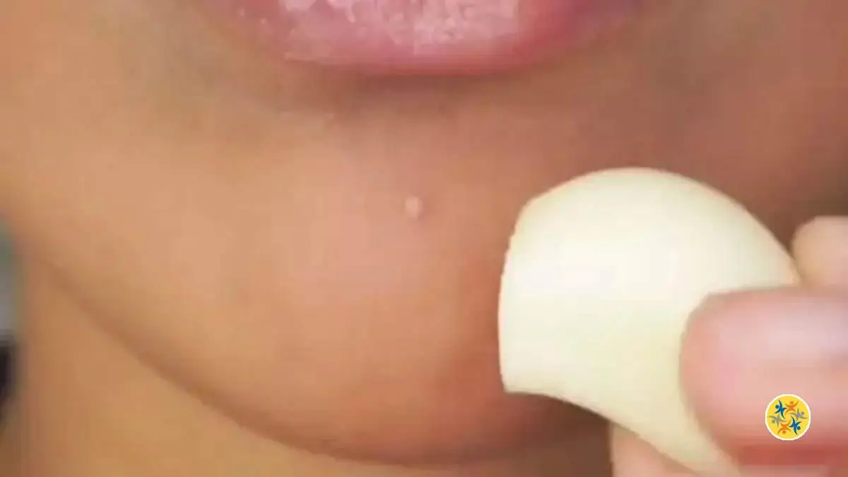 Garlic Remedy to Treat Acne Problems