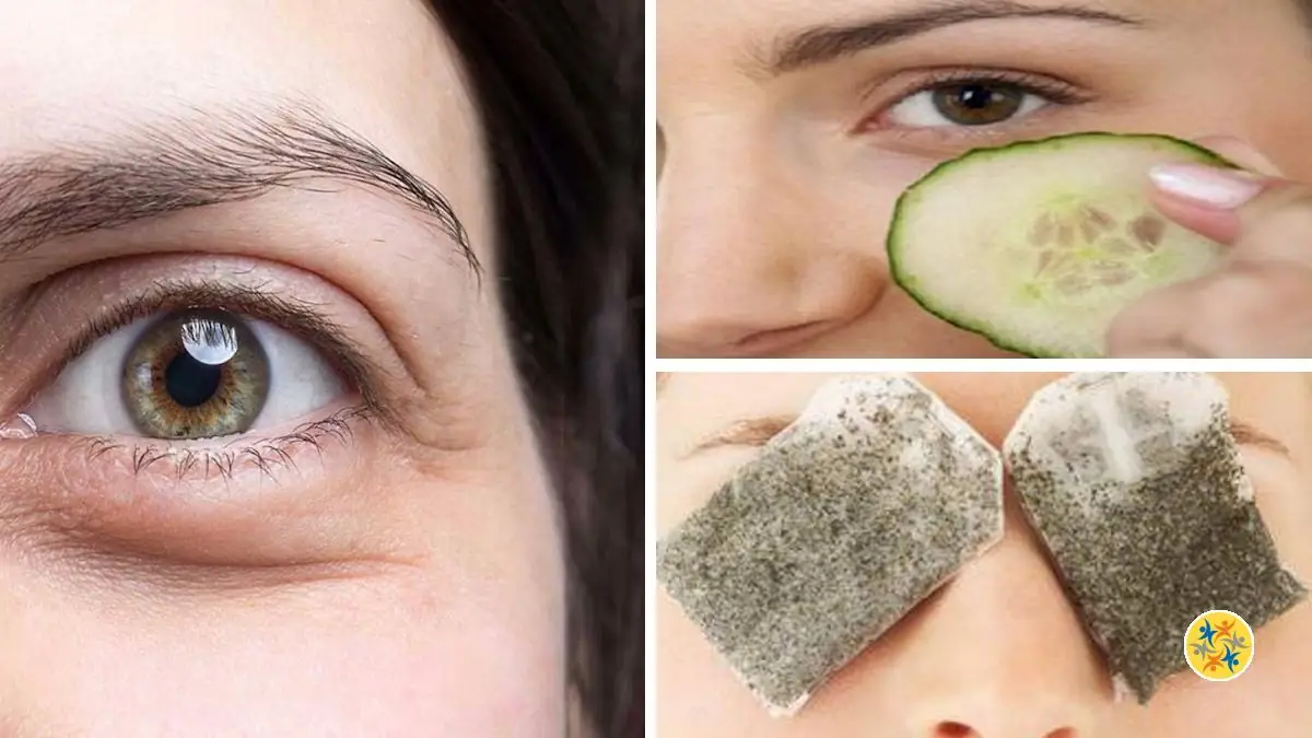 Astuces Naturelles Pour Des Yeux Sans Cernes