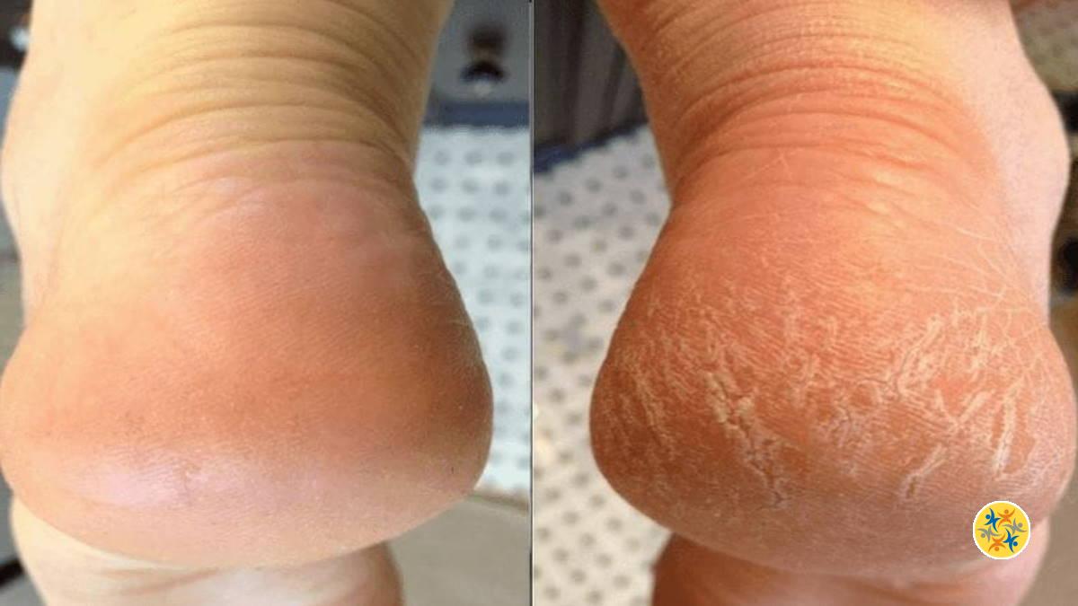 Pieds Secs: 2 Astuces Naturelles pour les Rendre Doux